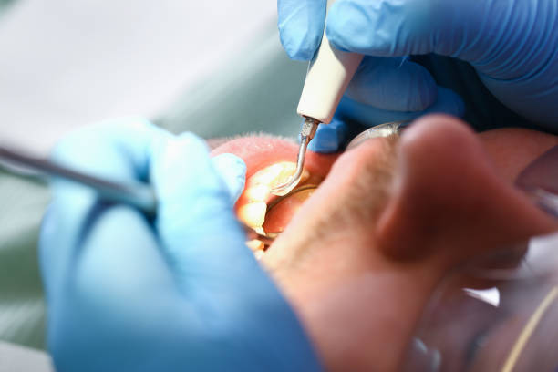 Best Emergency Dental Care for Broken or Chipped Teeth in Berry College, GA
